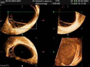 OvarianCyst