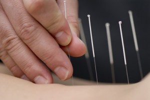 acupuncture-1